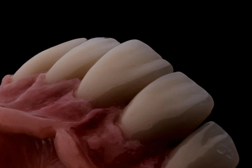 Dents prothétiques